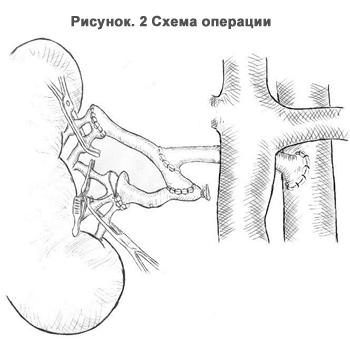 kidney_plan_operation_.jpg kidney_plan_operation_.jpg
