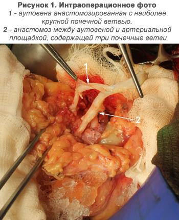 kidney_operation_1.jpg kidney_operation_1.jpg